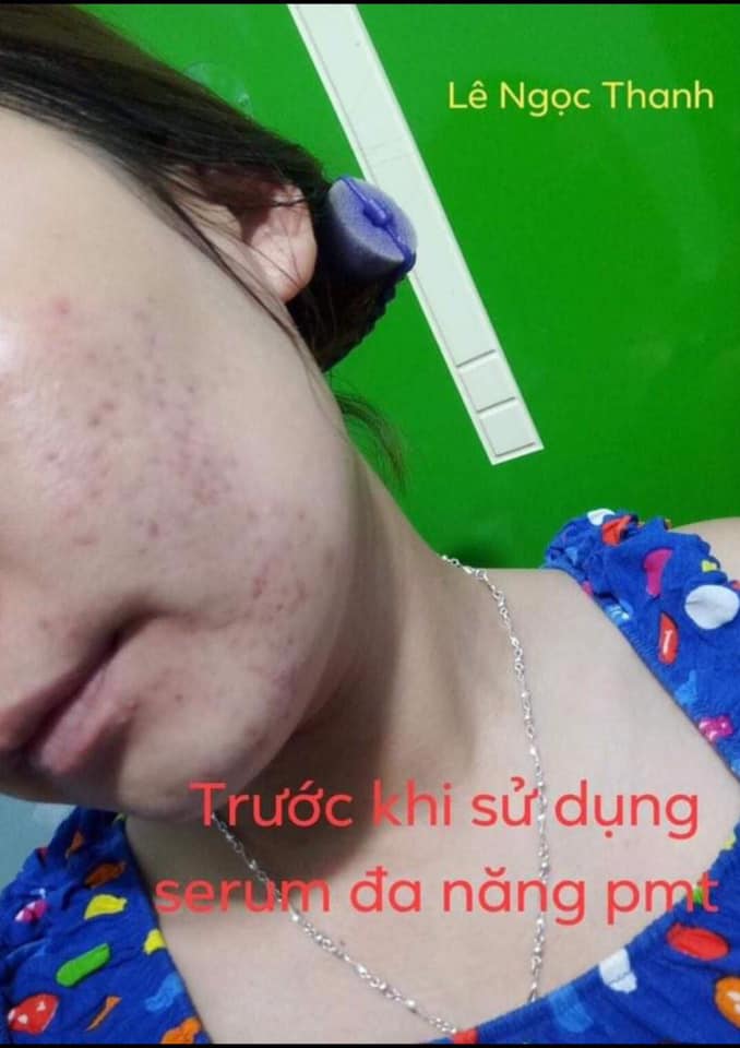 SERUM PHỤC HỒI THÂM NÁM 100% -  PHÚC MINH TÂM