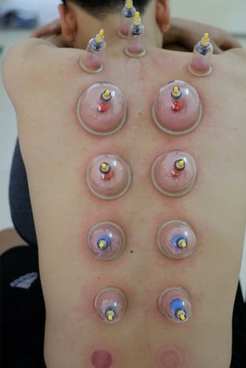 Bộ giác hơi chân không 32 cốc không dùng lửa