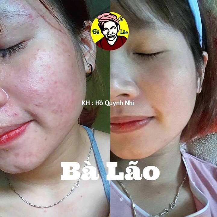 MỤN BÀ LÃO - KEM FACE DƯỠNG DA TRẮNG MỊN CHO DA