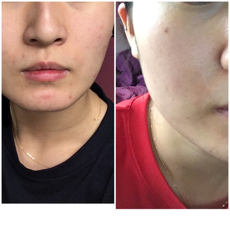 Gel Chấm Mụn Khẩn Cấp Isoi Acni Doctor 14ML