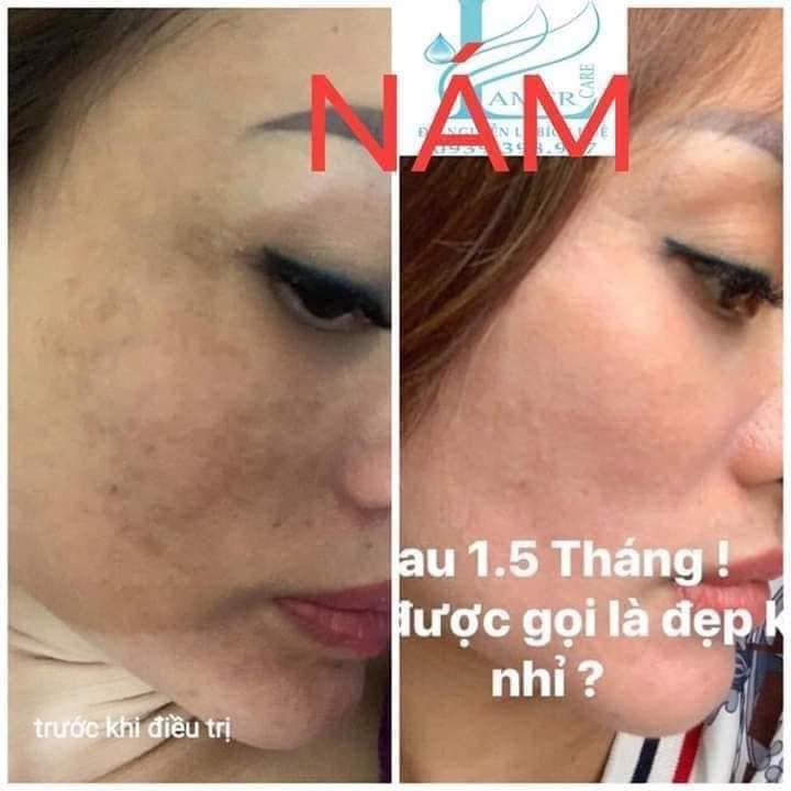 [HCM]Combo Nám Tảo Lamer Care - Dr. Lacir