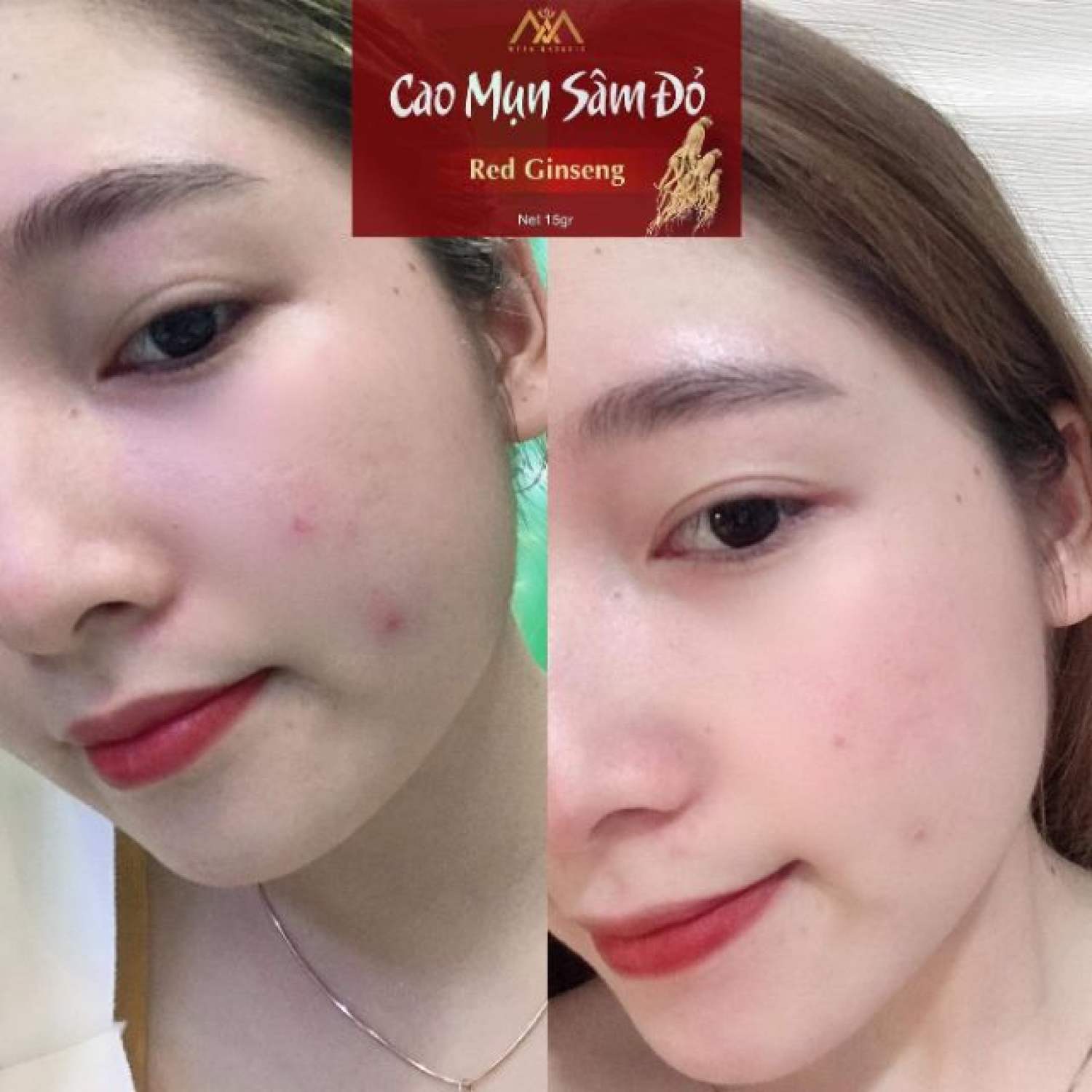 [HCM] Cao Mụn Sâm Đỏ 36 Vị - Sạch Mụn Mờ Thâm hộp 15gr