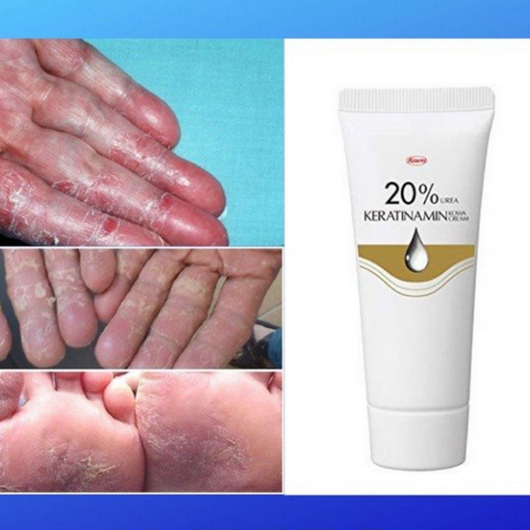 Tinh chất á sừng - viêm da Kowa