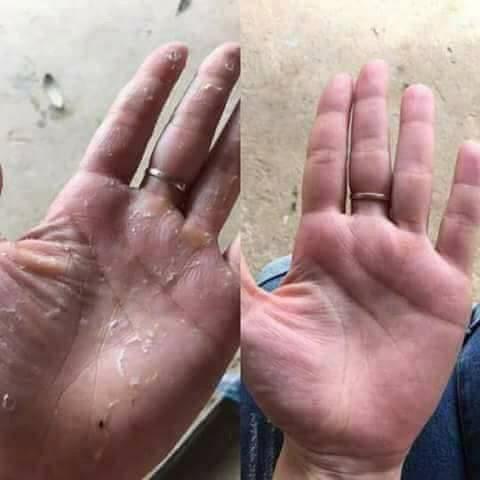 [HCM]Kem bôi da liễu
