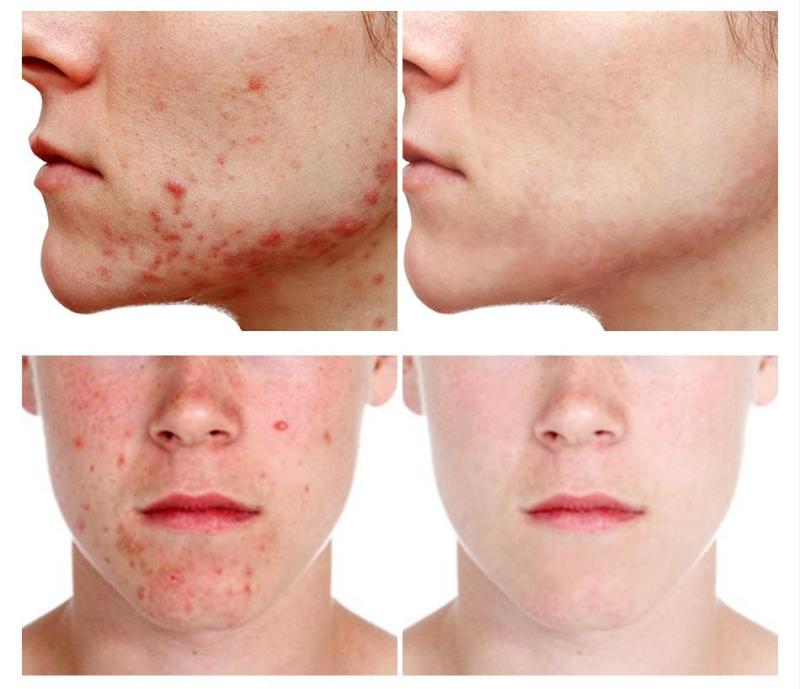 VG ance repair Serum Tea Tree Oil Scar Remover Shrink Pores ance oil treatment Whitening Anti-Aging Skin Care
