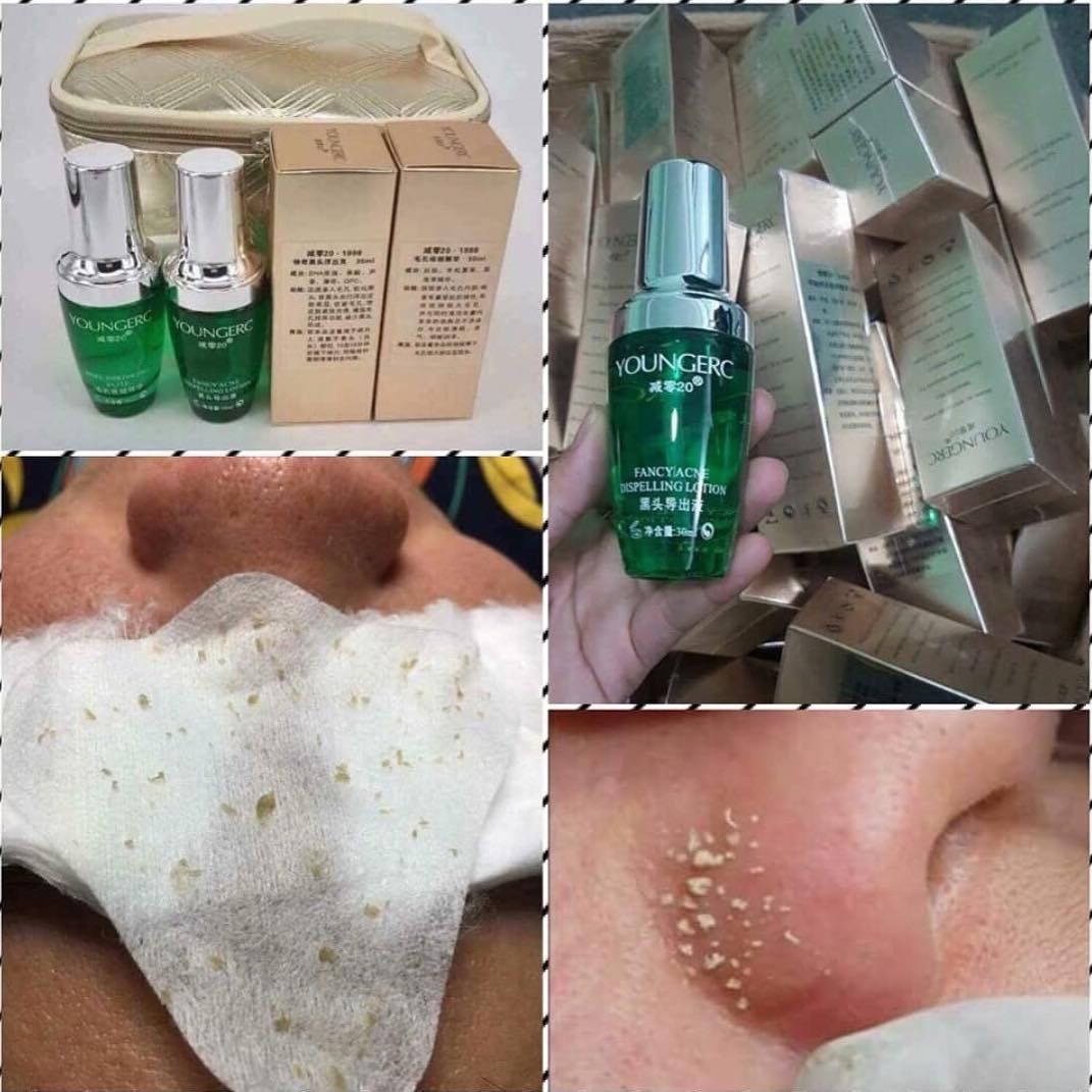 Ủ mụn đầu đen Younger