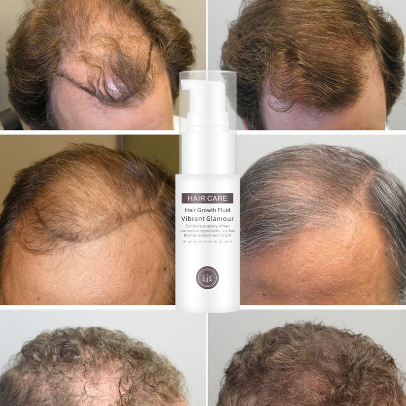 Tinh chất mọc tóc, ngăn ngừa rụng tóc, chai tinh dầu  giúp tóc mọc nhanh hơn, hiệu quả hơn, chống rụng tóc Tinh chất tăng trưởng tóc ,Hair Grower, Dầu xả tóc ,Tinh chất ngăn ngừa rụng tóc cho nam và nữ ,30ML nhập khẩu