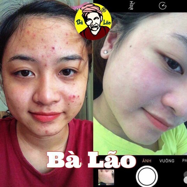 MỤN BÀ LÃO - KEM FACE DƯỠNG DA TRẮNG MỊN CHO DA