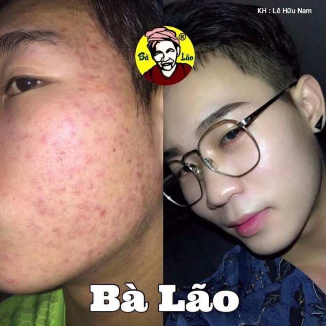 MỤN BÀ LÃO - KEM FACE DƯỠNG DA TRẮNG MỊN CHO DA