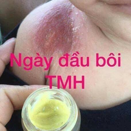 [HCM]Kem bôi da liễu