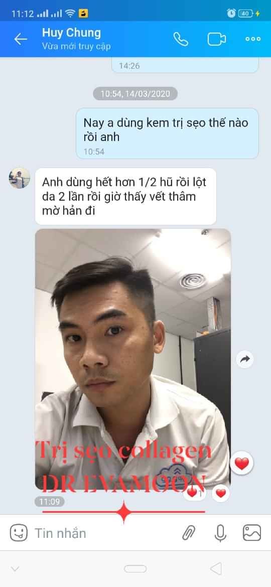 Cao sẹo rỗ collagen