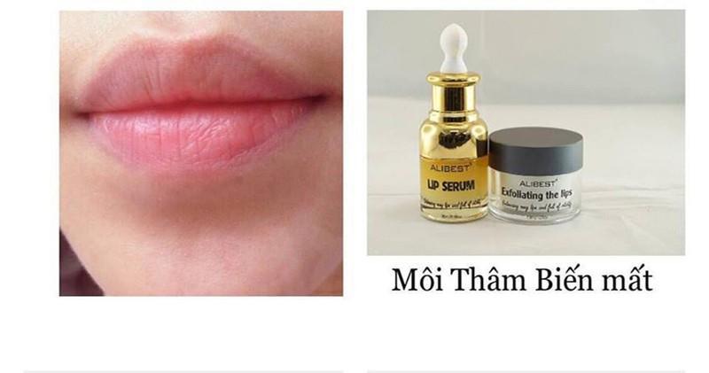 Bộ Trị Thâm Môi Alibest - Hiệu Quả Chỉ Sau 7 Ngày giá rẻ