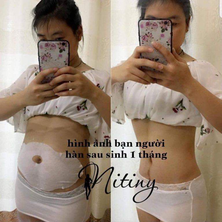 Giảm cân nhỏ cuống rốn Nitiny Hàn Quốc