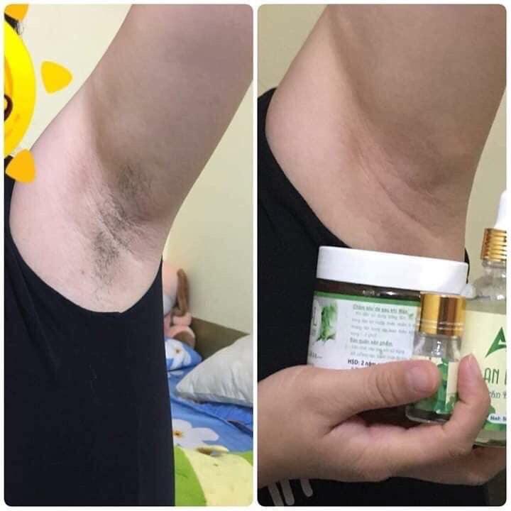 Combo triệt lông từ wax lông và mỡ trăn An Lành (tặng kèm giấy)