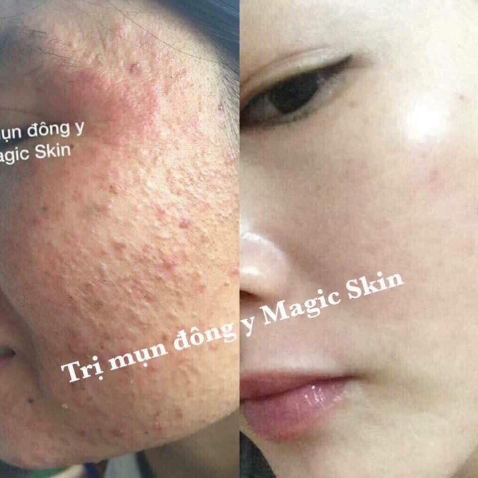 Tinh Chất Ngừa Mụn Đông y