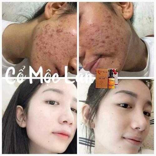 [HCM]Cổ Mộc Lan Siêu Tốc 50ml