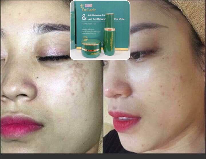 [HCM]Combo Nám Tảo Lamer Care - Dr. Lacir