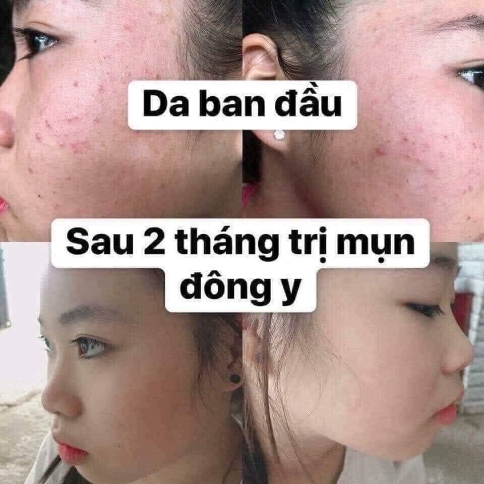 Tinh Chất Ngừa Mụn Đông y