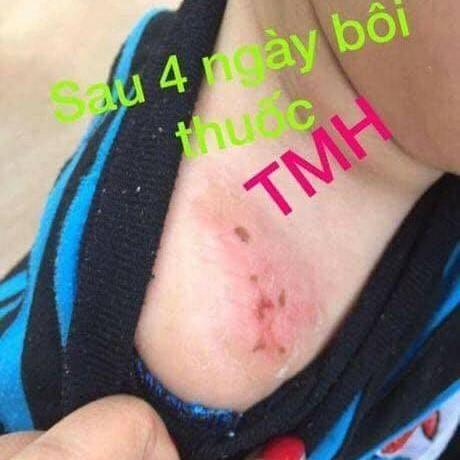 [HCM]Kem bôi da liễu