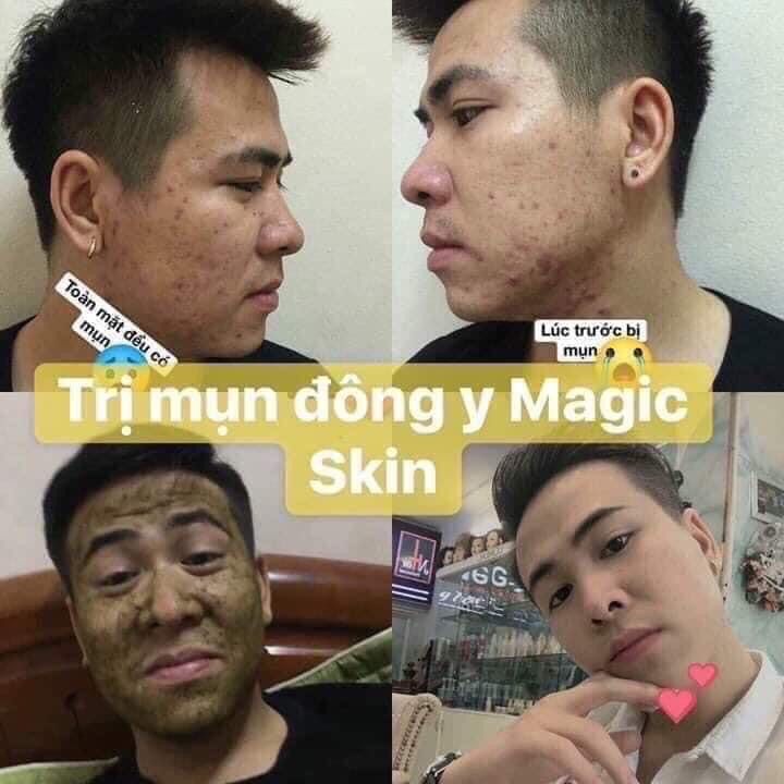 Tinh Chất Ngừa Mụn Đông y