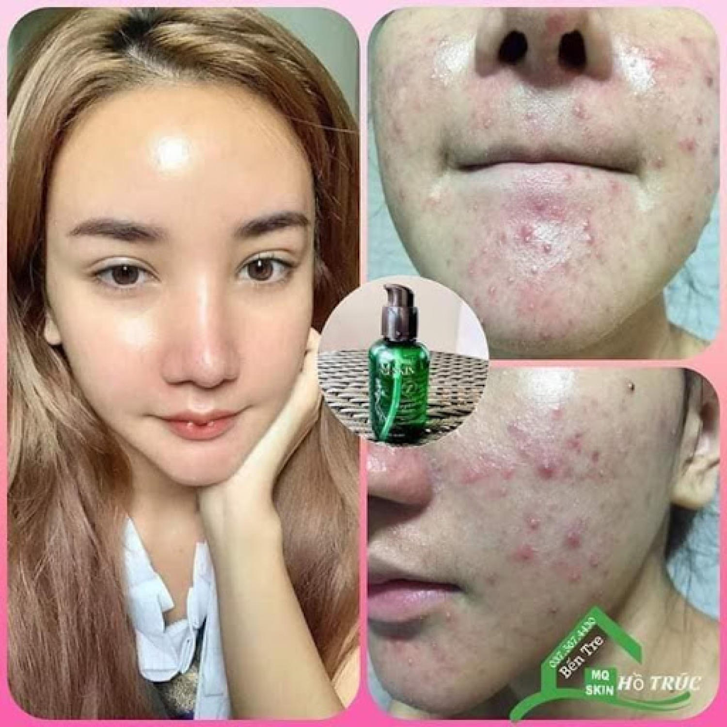 [HCM]COMBO Bột Rửa Mặt MQ + SERUM Thay Da Nhân Sâm