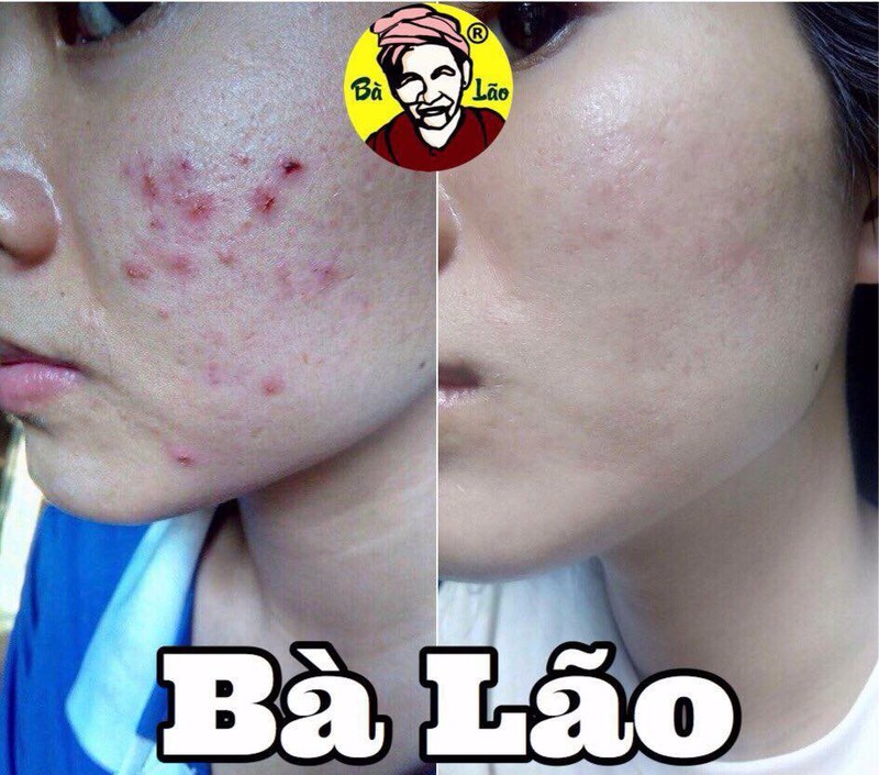 MỤN BÀ LÃO - KEM FACE DƯỠNG DA TRẮNG MỊN CHO DA