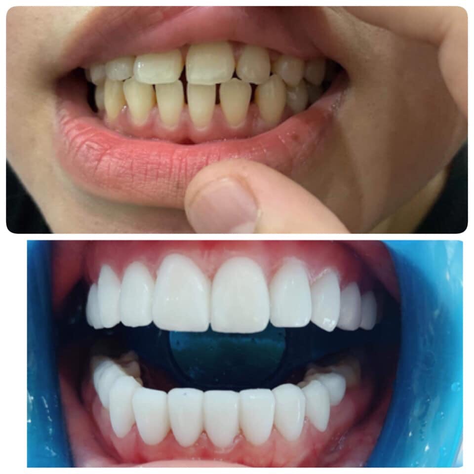 đèn chiếu phủ bóng răng biox..phủ trám răng sứ xinh học