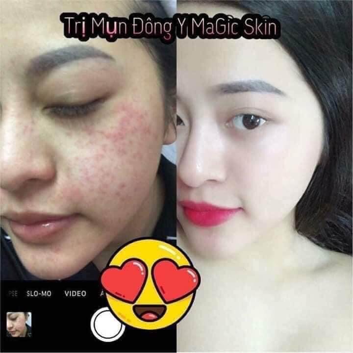 ComBo Sạch Mụn Hết Thâm 100%