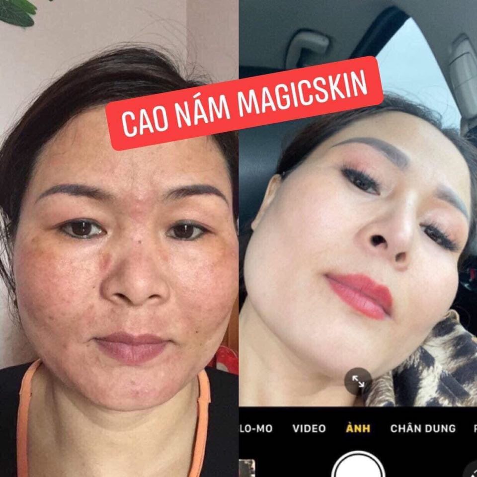 Cao Nám MagicSkin