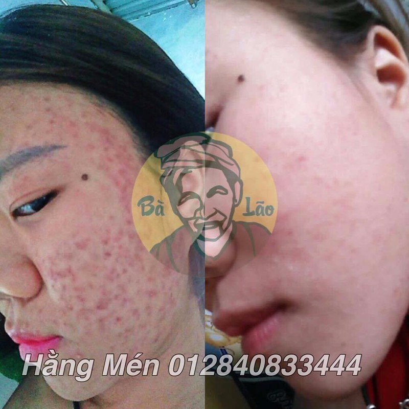 MỤN BÀ LÃO - KEM FACE DƯỠNG DA TRẮNG MỊN CHO DA