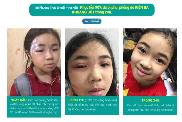 Gel bôi Nano Bạc PlasmaKare No5 kháng khuẩn, kháng nấm, virus...chống viêm, giảm ngứa, tái tạo da, chuyên sâu cho bệnh về da