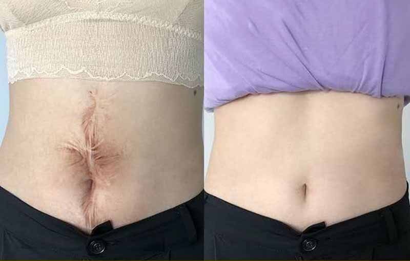 Kem Hết Rạn Da, Hết Sẹo Hiệu Quả Treatment Body Cream Thương Hiệu VIBRANT GLAMOUR Làm Trắng Và Săn Chắc Mịn Mượt Chống Lão Hóa