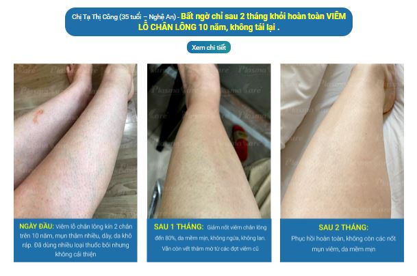 Gel bôi Nano Bạc PlasmaKare No5 kháng khuẩn, kháng nấm, virus...chống viêm, giảm ngứa, tái tạo da, chuyên sâu cho bệnh về da