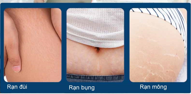 Kem Hết Rạn Da, Hết Sẹo Hiệu Quả Treatment Body Cream Thương Hiệu VIBRANT GLAMOUR Làm Trắng Và Săn Chắc Mịn Mượt Chống Lão Hóa