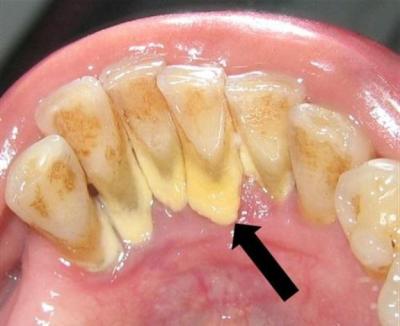 Trắng răng than hoạt tính SMILE UP hủ 100g