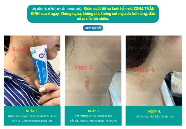 Gel bôi Nano Bạc PlasmaKare No5 kháng khuẩn, kháng nấm, virus...chống viêm, giảm ngứa, tái tạo da, chuyên sâu cho bệnh về da