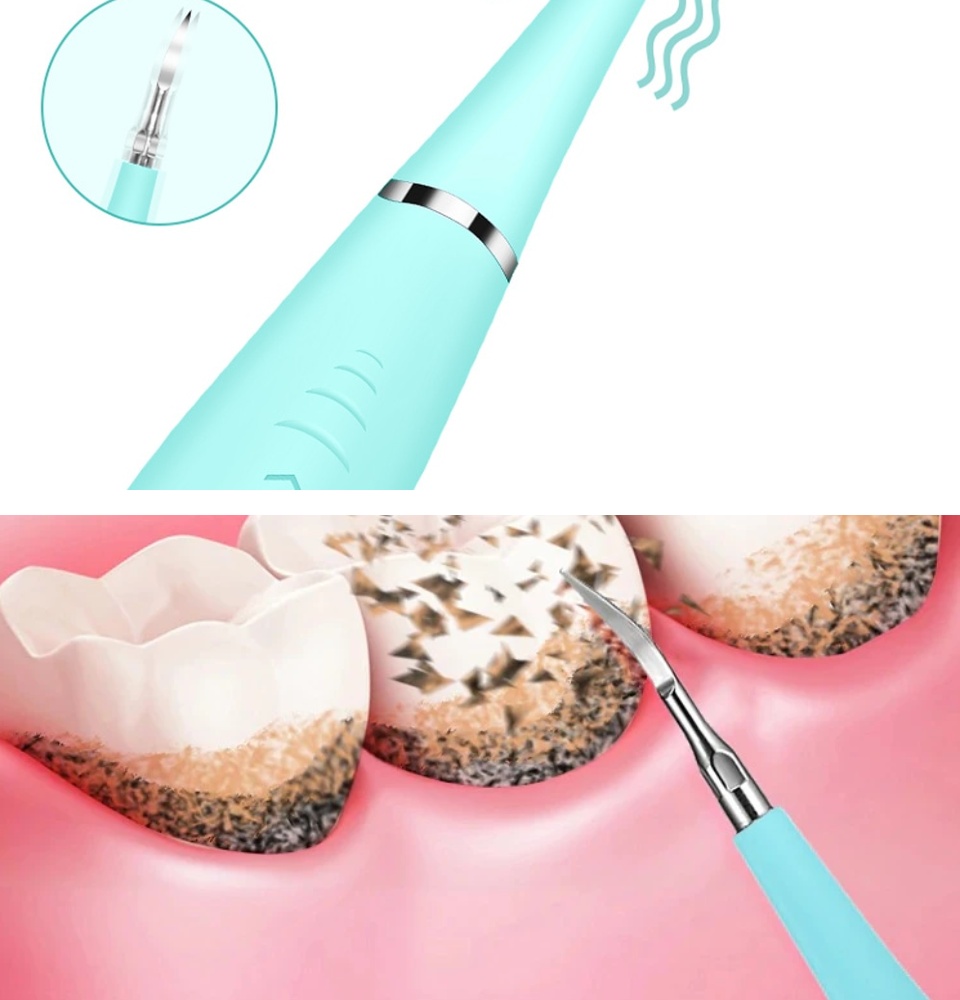 Tự lấy cao răng bằng máy cầm tay có thể làm tổn thương nướu/lợi nếu bạn sử dụng không đúng kỹ thuật