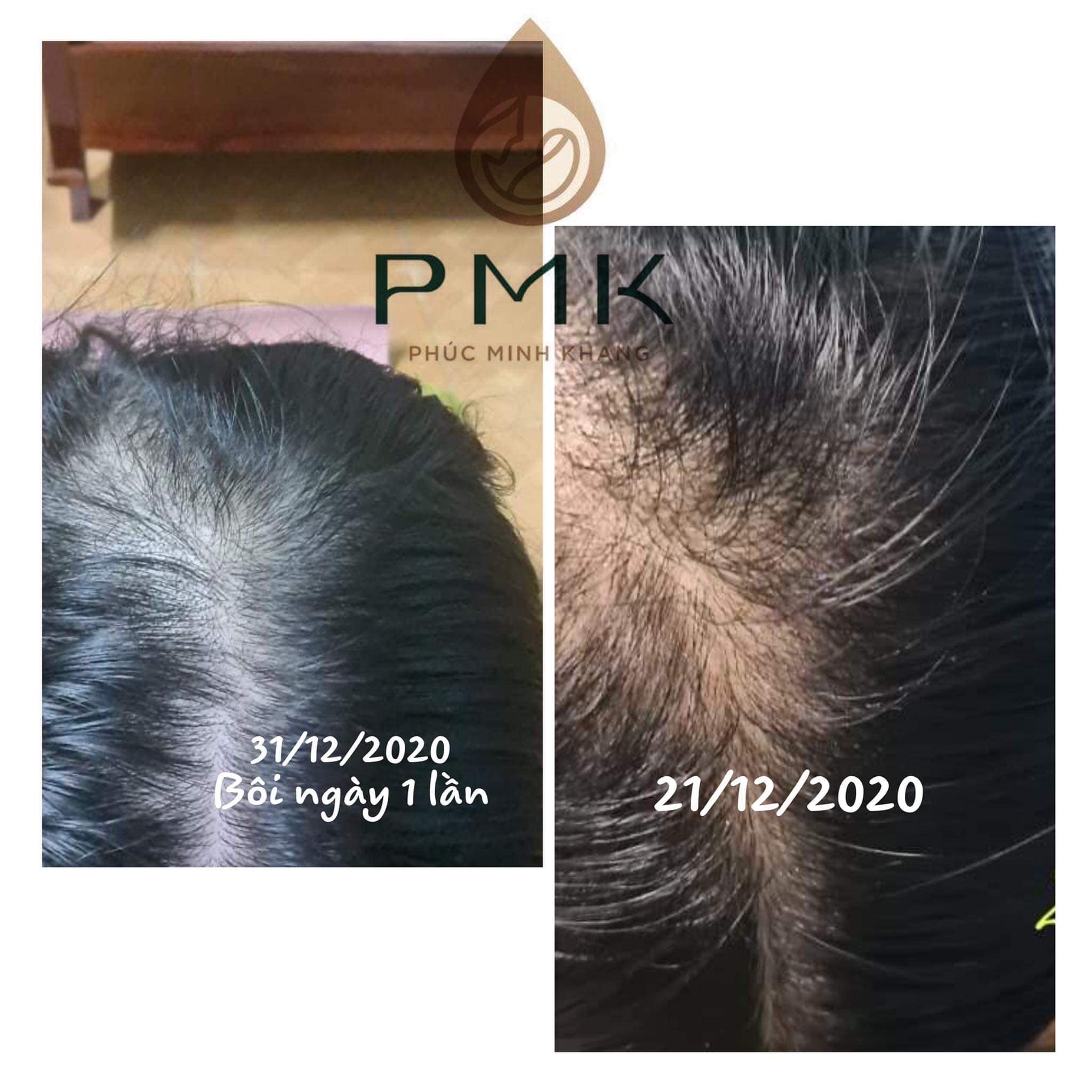 Tinh Chất Tóc Cao cấp Minh Khang - Kích Thích Mọc Tóc & Ngăn Ngừa Rụng Tóc Cực Kì Hiệu Quả [DTM]