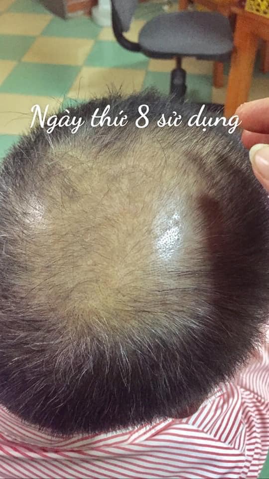 Tinh Chất Tóc Cao cấp Minh Khang - Kích Thích Mọc Tóc & Ngăn Ngừa Rụng Tóc Cực Kì Hiệu Quả [DTM]