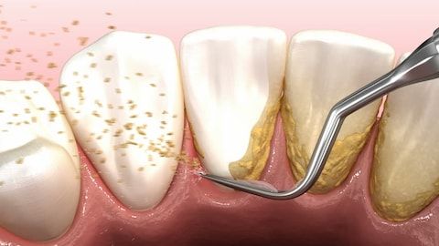 Máy lấy cao răng Siêu âm cao cấp, Dụng cụ lấy cao răng mini , Bộ dụng cụ lấy cao răng tại nhà, Máy lấy cao răng cao cấp Sử Dụng Sạc 3 Chế Độ Rung Loại Sạch Mảng Bám, Cao Răng vết ố răng