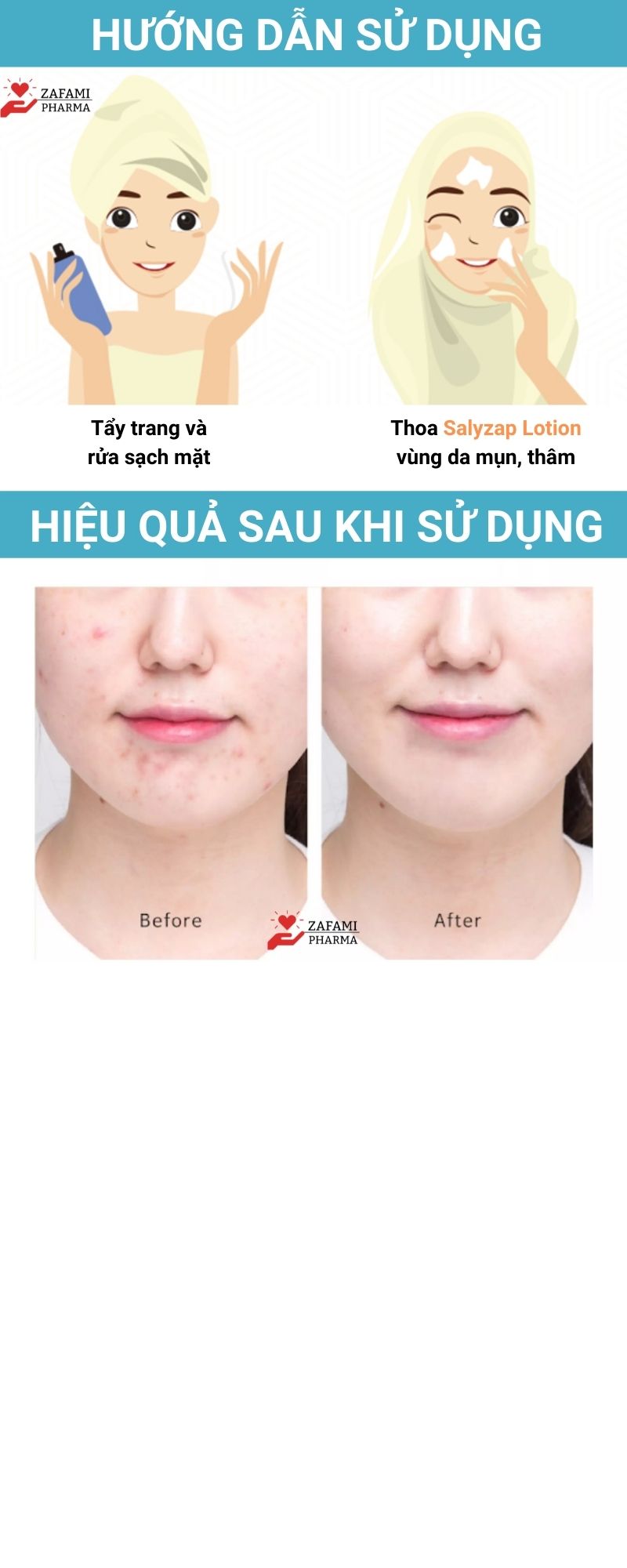 Chấm mụn Fixderma Salyzap kem chấm mụn, tẩy tế bào chết, đánh bay mụn ẩn, mụn đầu đen, giảm thâm da mụn, có thể thay thế chấm mụn neogen, differin, miếng dán mụn (20ml) - Zafami Pharma
