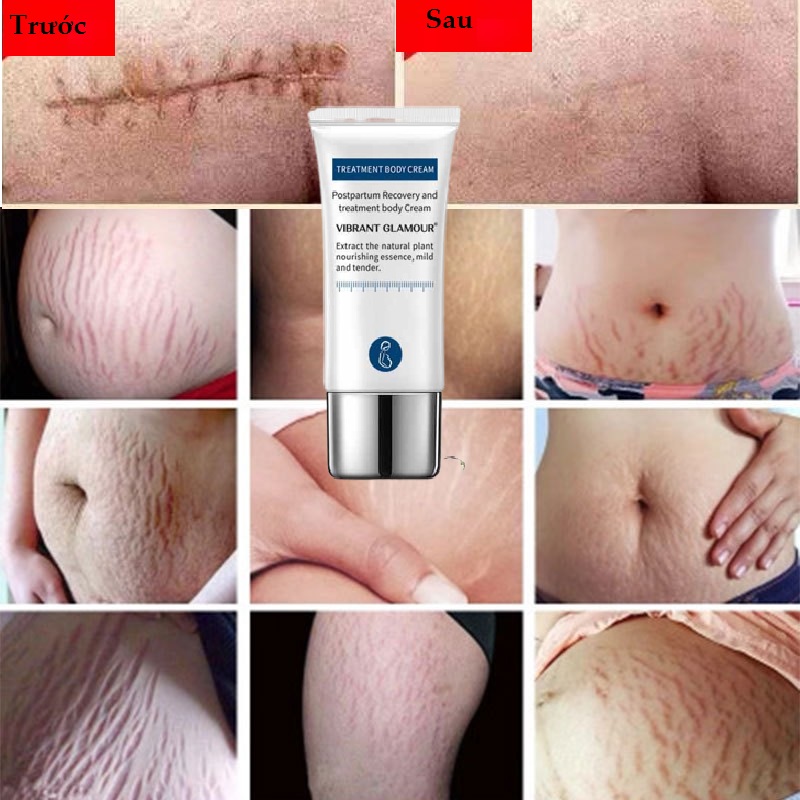 Kem Hết Rạn Da, Hết Sẹo Hiệu Quả Treatment Body Cream Thương Hiệu VIBRANT GLAMOUR Làm Trắng Và Săn Chắc Mịn Mượt Chống Lão Hóa