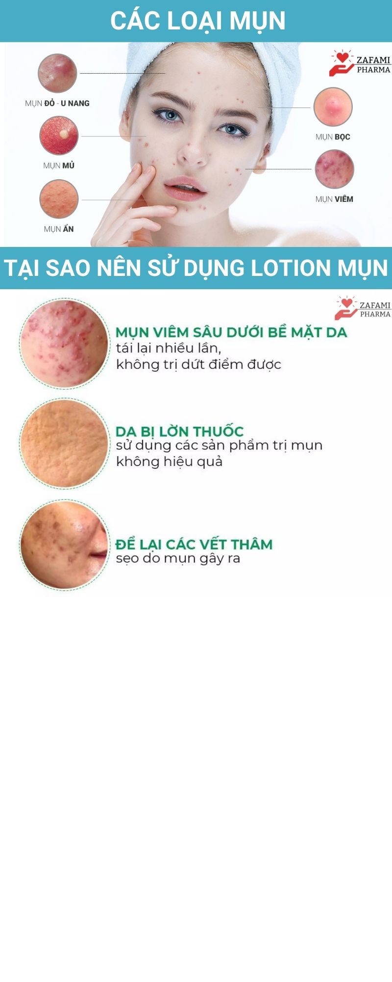 Chấm mụn Fixderma Salyzap kem chấm mụn, tẩy tế bào chết, đánh bay mụn ẩn, mụn đầu đen, giảm thâm da mụn, có thể thay thế chấm mụn neogen, differin, miếng dán mụn (20ml) - Zafami Pharma